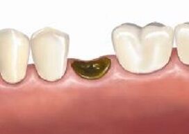 Complicacións despois da extracción de dentes